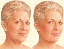 Incision area for a facelift