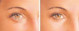 Boston upper eyelid surgery graphic