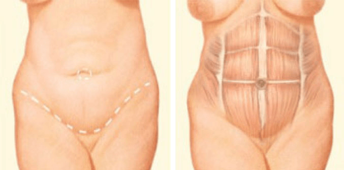 Boston Tummy Tuck Incision graphic