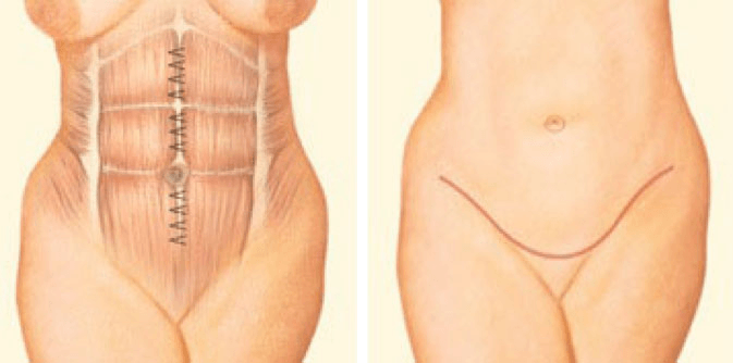 Boston Tummy Tuck internal sutures graphic