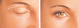 Boston upper eyelid surgery graphic