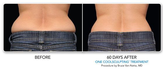 Coolsculpting Before and After photos