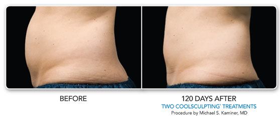 Coolsculpting Before and After photos