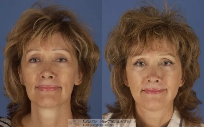 Front view of woman before and after facelift surgery.
