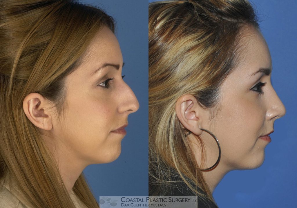 Before and after photos of a woman in her 20s who received rhinoplasty at Coastal Plastic Surgery